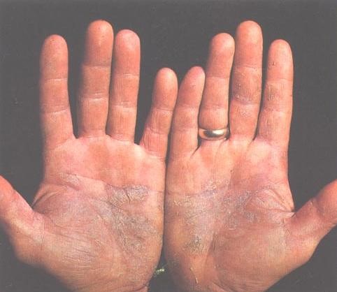 Chomutovští dermatologové vyzývají psoriatiky – chtějte více pro svou kůži