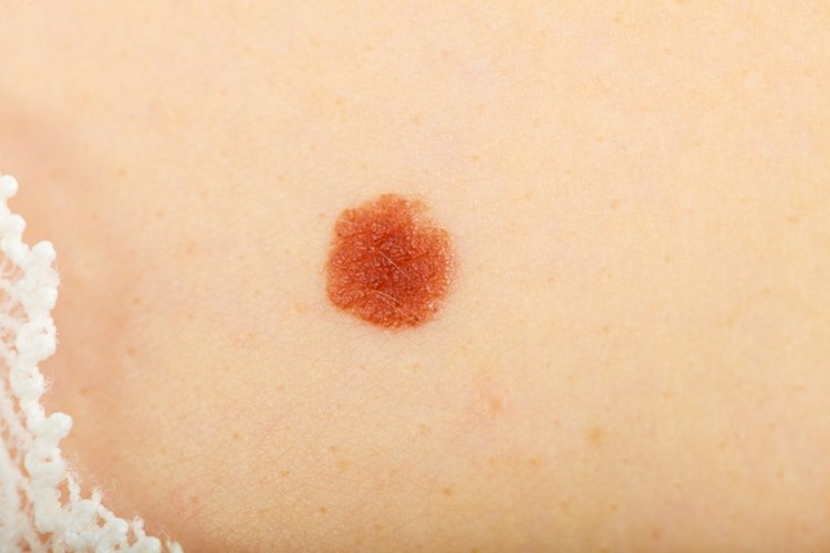 Odborníci varují před nebezpečnými paprsky: počet nemocných kožním melanomem stále vzrůstá
